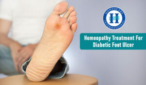 Homeopathy treatment for diabetic foot ulcer